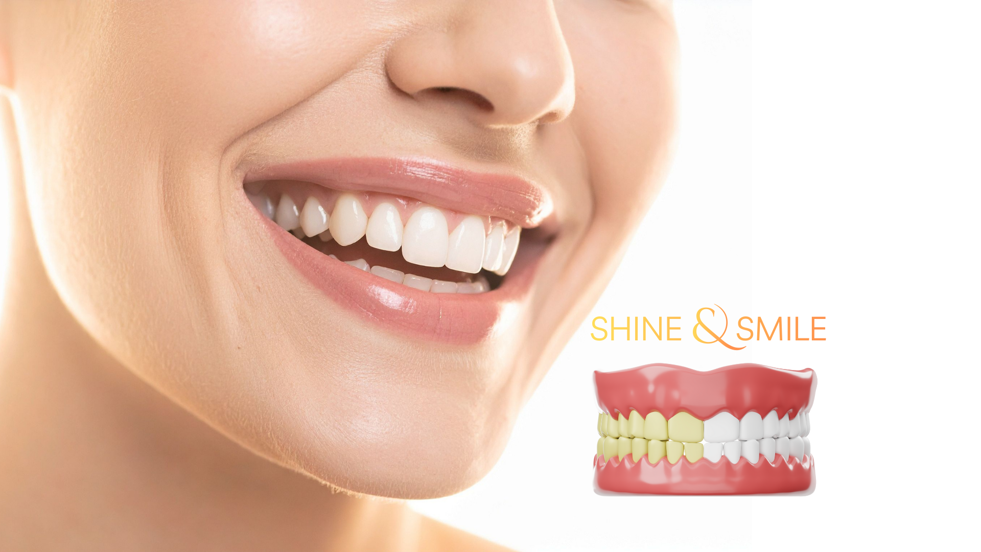 Diş beyazlatma İzmir Bayraklı - Estetik diş hekimliği